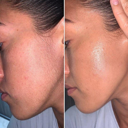 Alluvea™  Facial Hair Removal Cream